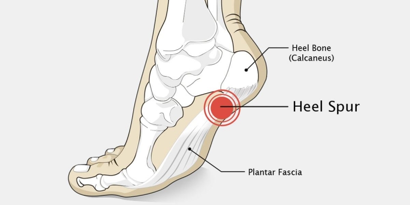 Heel Pain Treatment in Homeopathy