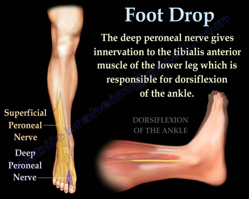 Foot drop - Diagnosis and treatment - Mayo Clinic