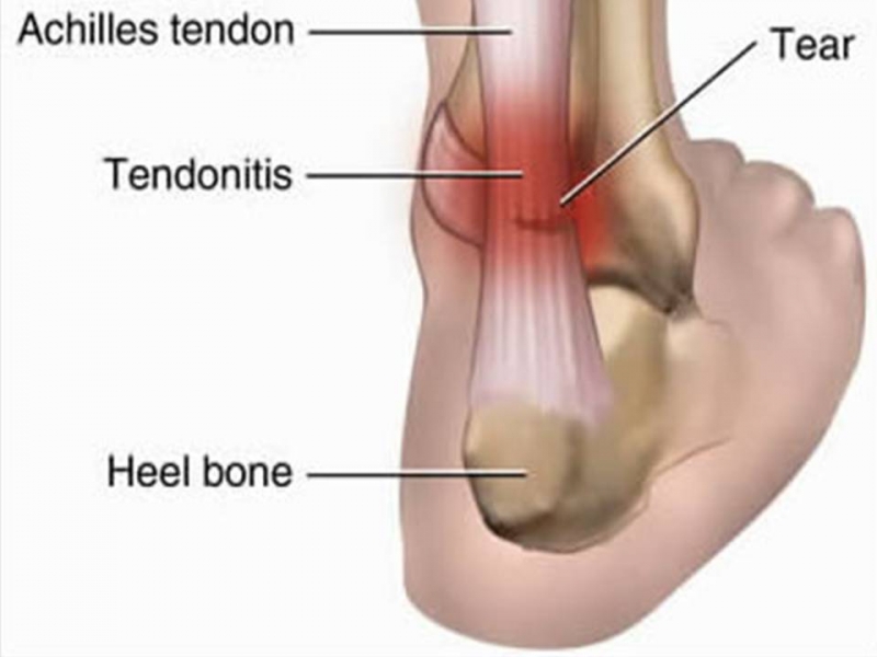 Achilles Tendonitis | Diagnosis, Treatment & Rehabilitation Exercises